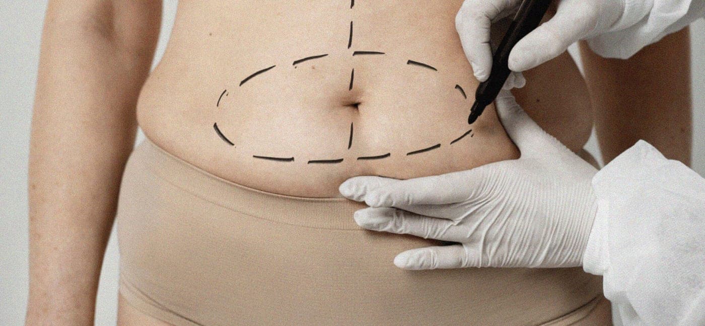 Mano con guante dibujando marcas de liposucción en el abdomen
