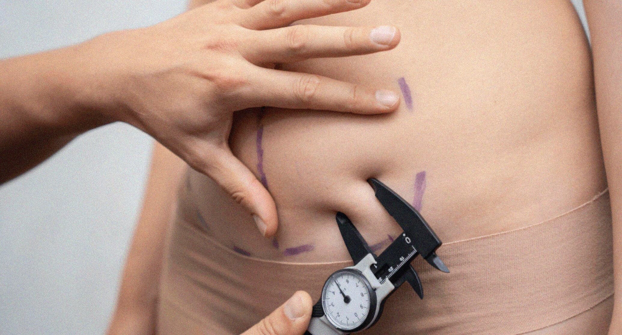 Measuring skin and fat thickness with a caliper before liposuction