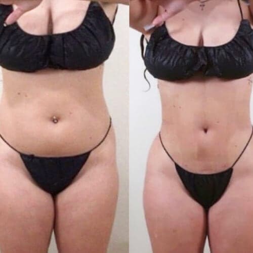 Before and after: Liposuction to upper and lower abdomen, both flanks and sacral triangle