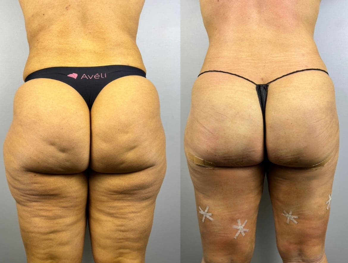 Antes y después: liposucción para lipedema, parte posterior de los muslos
