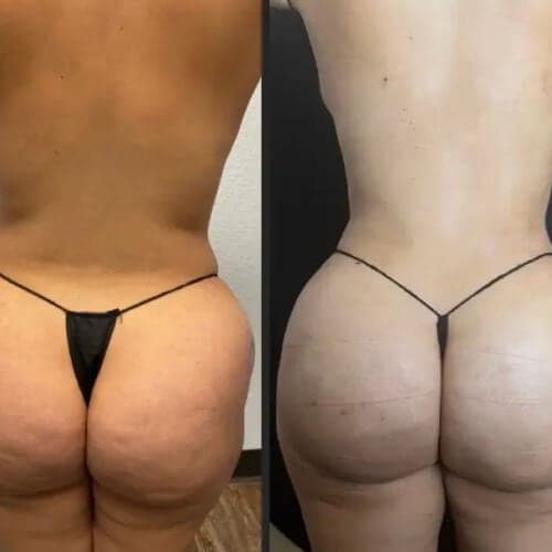 Before and after: Lipo 360 plus BBL