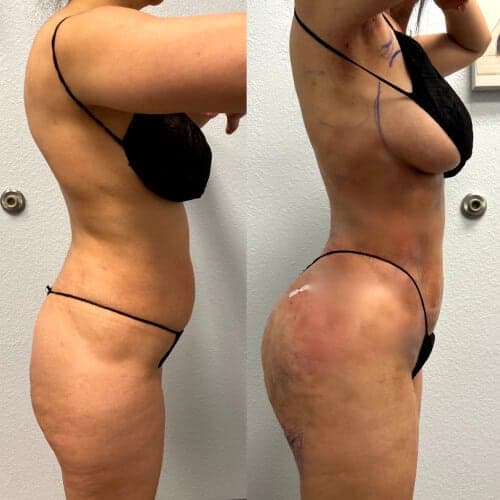 Before and after: Lipo 360 plus BBL plus Renuvion