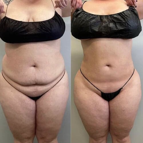 Before and after: Lipo 360 plus Renuvion, 32 year old female