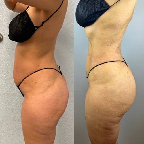 Antes y después: Lipo 360 más BBL