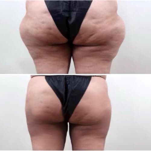 Before and after: Lipomas on the saddlebags removed with liposuction