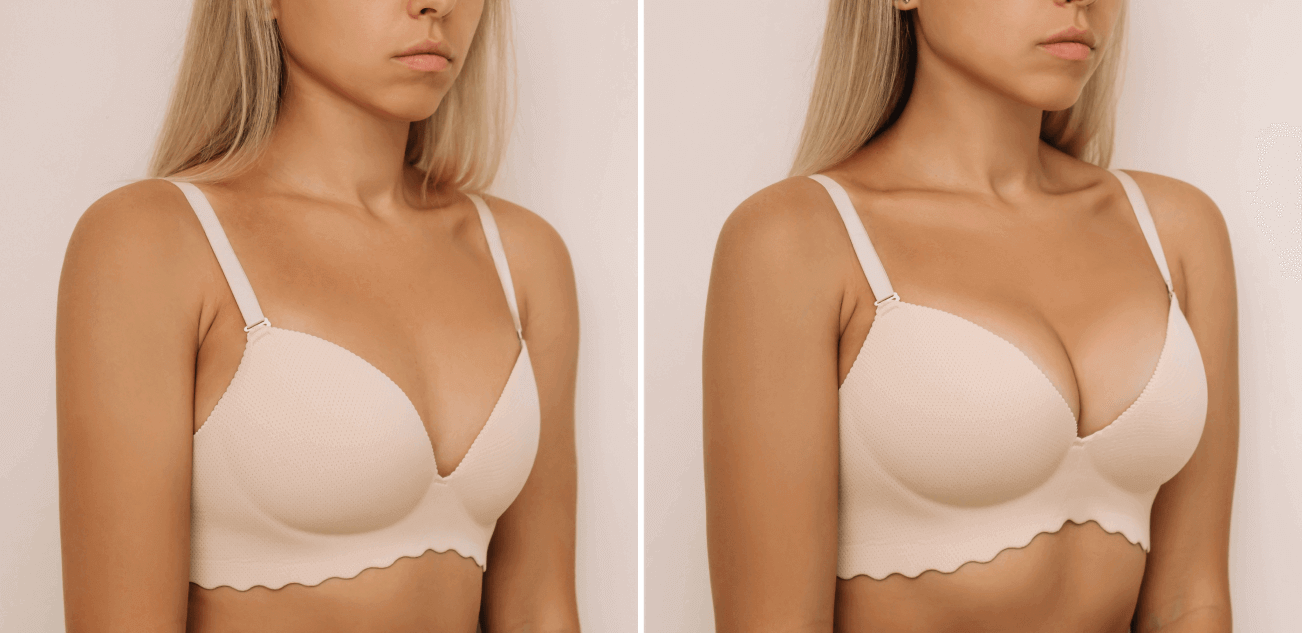 Breast implants vs natural augmentation comparison, pros and cons of each option.