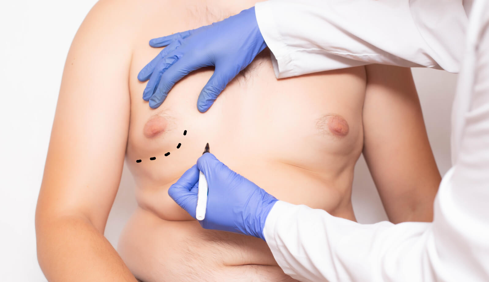 Gynecomastia Stages & Treatment