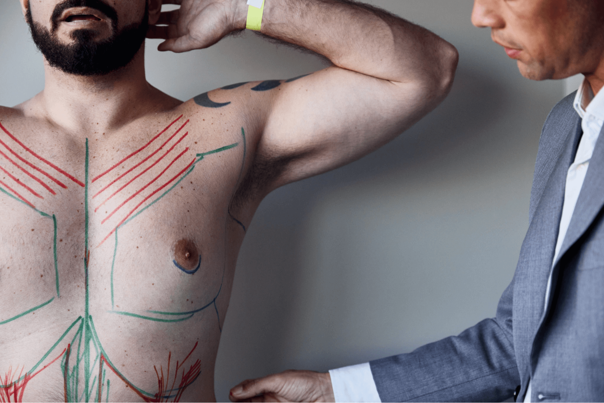 Tips to minimize liposuction scars, treatments and recovery advice.