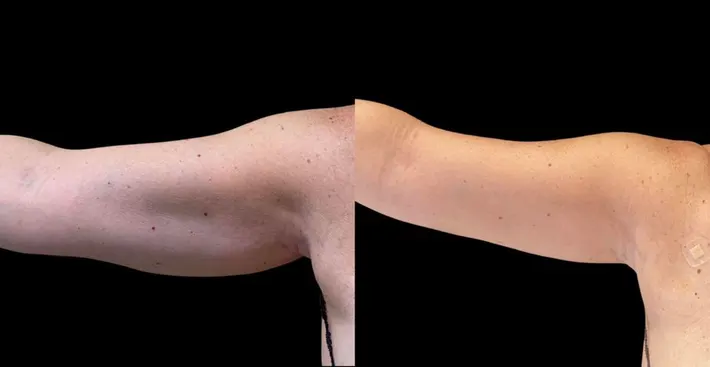 Liposuction results and recovery timeline.